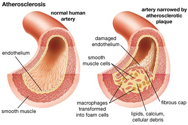 atherosclerosis-anatomy-physiology