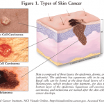 Skin Cancer: Carcinoma & Melanoma