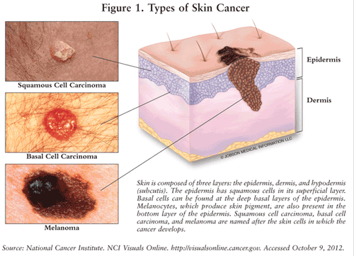 Basal cell carcinoma, squamous cell carcinoma, melanoma. Skin cancer.